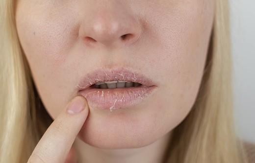 Conheça sobre a xerostomia: sensação de boca seca