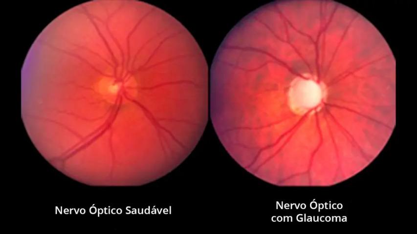 exames de glaucoma em Maringá