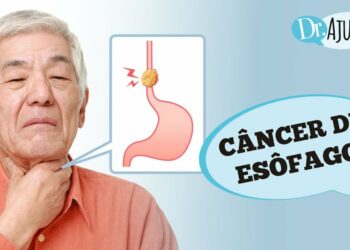 Câncer de Esôfago: quais os sintomas e o tratamento?