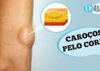 O que podem ser caroços na pele? O que é lipoma?