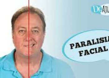 Paralisia facial: causas e tratamento