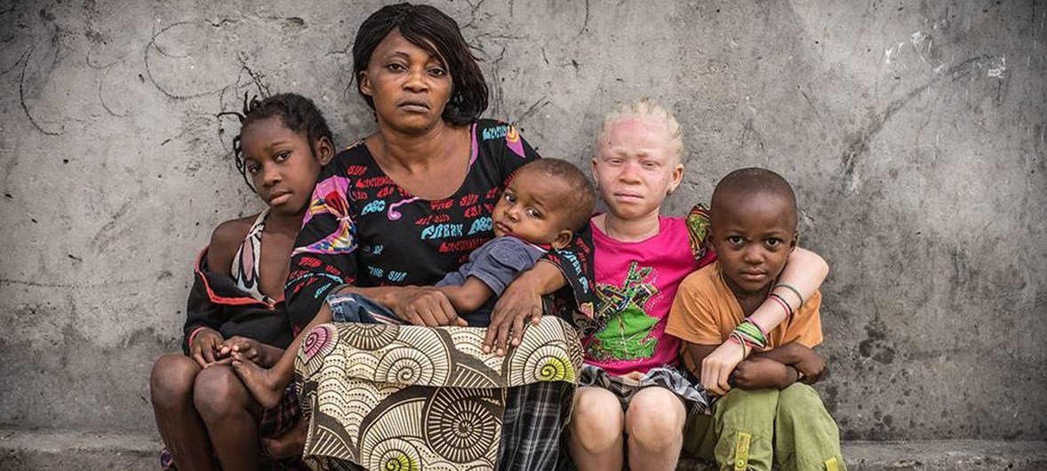 As pessoas afetadas pelo albinismo são frequentemente deficientes visuais e precisam de proteção especial contra o sol. Eles frequentemente desenvolvem câncer de pele e sofrem de estigmatização social, de acordo com o Unicef.