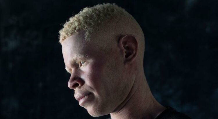 ONU marca Dia Internacional sobre Conscientização para o Albinismo