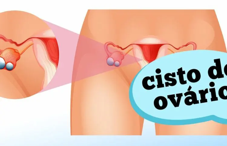 Quando se preocupar com um cisto de ovário?