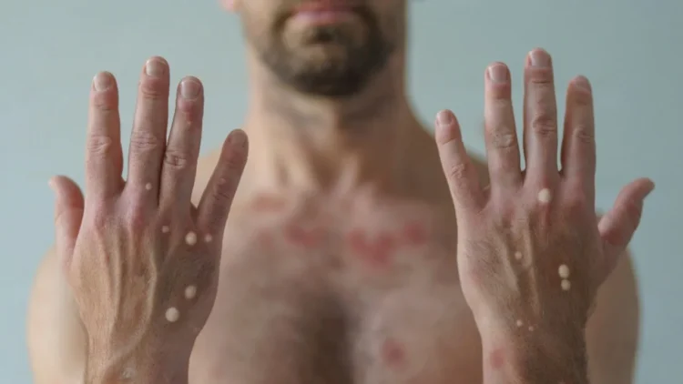 Brasil já registrou 88 casos de Mpox em 2026