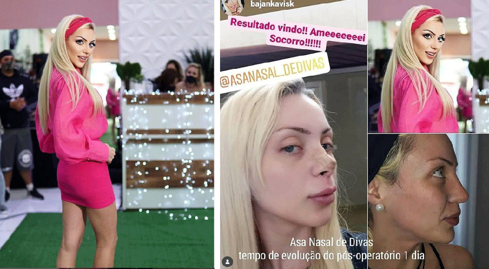 Justiça manda exumar corpo da Barbie Humana para saber se ela foi assassinada