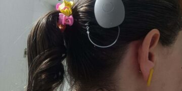 Paraná assume liderança em implante coclear pelo SUS