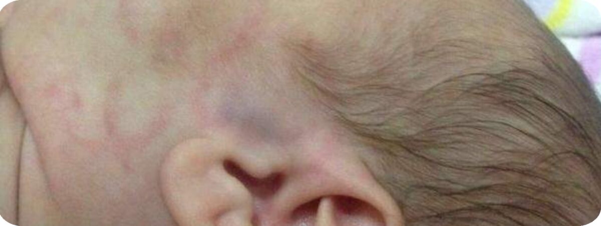 Recém-nascida por ter sido vítima de agressão e os pais são suspeitos