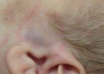 Recém-nascida por ter sido vítima de agressão e os pais são suspeitos