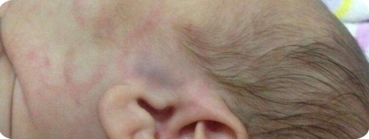 Recém-nascida por ter sido vítima de agressão e os pais são suspeitos